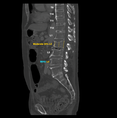 Osteoporosis detection | Nanox AI